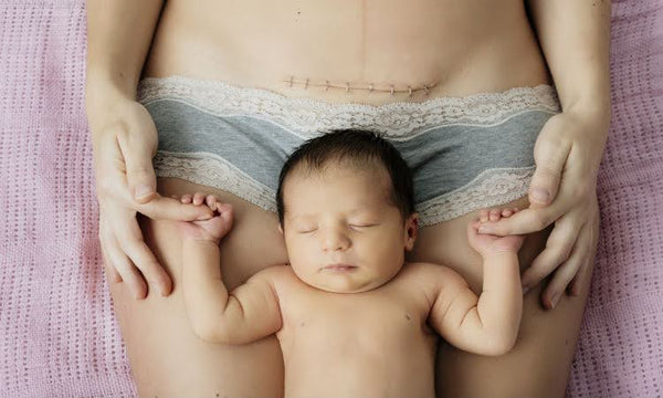 A newborn resting peacefully against mama, with a visible C-section scar